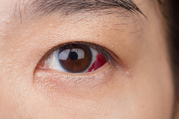 Recognizing and Treating Eye Injuries