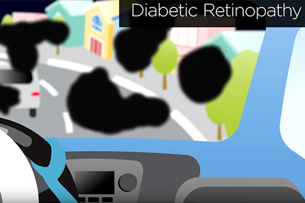 Detecting Cataracts, Diabetic Retinopathy, Glaucoma, Macular Degeneration